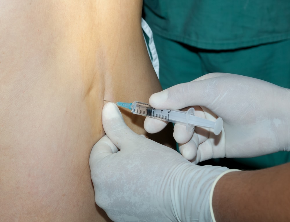 Epidural - Everything You Should Know About It